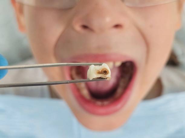 Best Urgent Care for Lost Fillings or Crowns in Blackwater, AZ